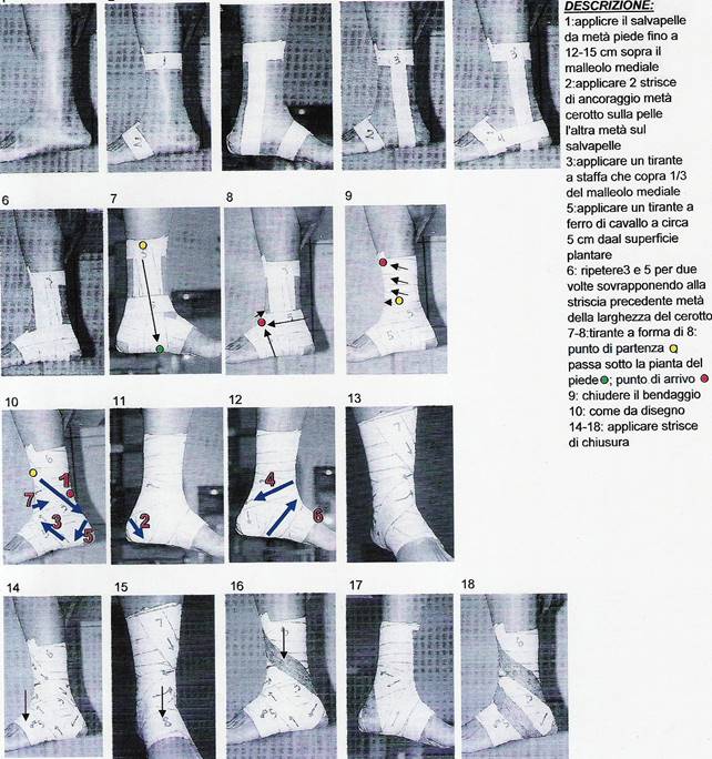 distorsione alla caviglia